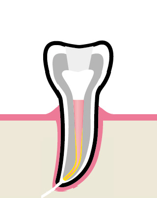 Вертикальная конденсация - финиш
